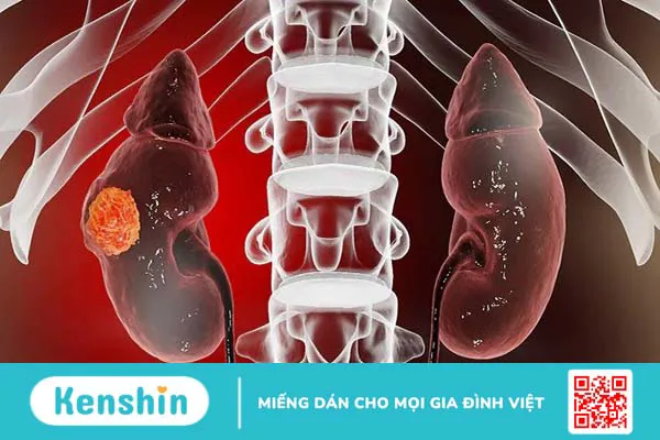 Đi tiểu ra máu là bệnh gì? 8 nguyên nhân tiểu ra máu bạn nên biết