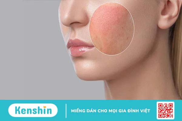 Dị ứng mỹ phẩm: Dấu hiệu nhận biết và cách xử lý kịp thời cho da