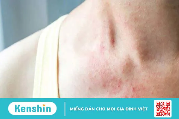 Dị ứng tinh trùng và các dấu hiệu dị ứng tinh dịch mà chị em cần biết