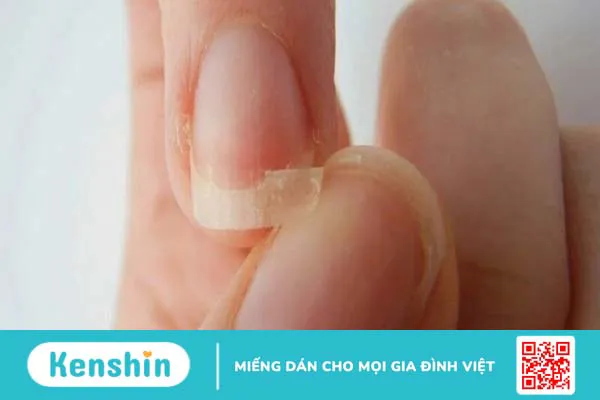 Điểm qua 16 triệu chứng hạ canxi máu bạn không thể bỏ qua