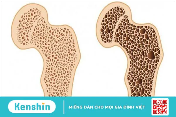 Điểm qua 16 triệu chứng hạ canxi máu bạn không thể bỏ qua