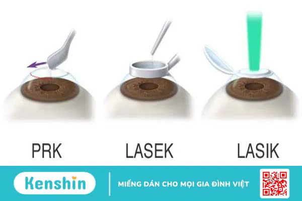 Điều trị chứng loạn thị