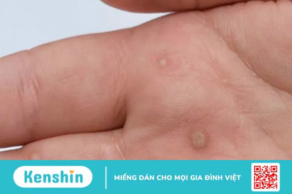 Điều trị mụn cóc bằng giấm táo đơn giản tại nhà