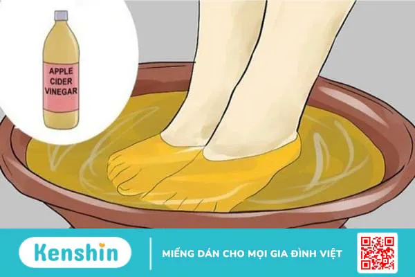 Điều trị mụn cóc bằng giấm táo đơn giản tại nhà