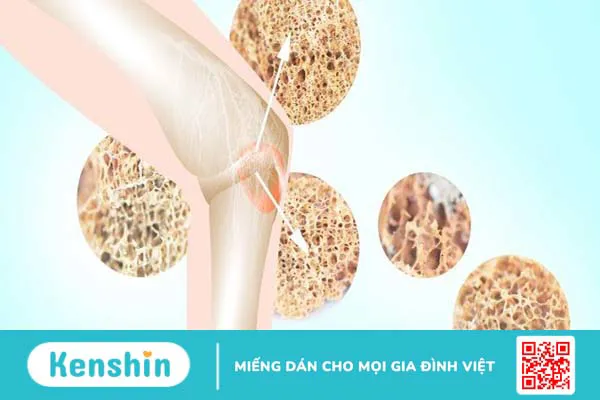 Đo mật độ xương là gì? Ai nên kiểm tra loãng xương