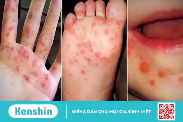 Dùng biện pháp dân gian chăm sóc trẻ bị tay chân miệng cần lưu ý gì?