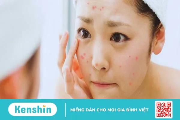 Dùng kem chống nắng bị mụn? 7 nguyên nhân gây mụn và cách khắc phục