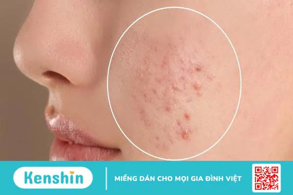 Dùng kem chống nắng bị mụn? 7 nguyên nhân gây mụn và cách khắc phục