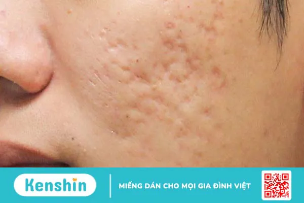 Elastin là gì? 6 tác dụng của elastin đối với làn da bạn nên biết