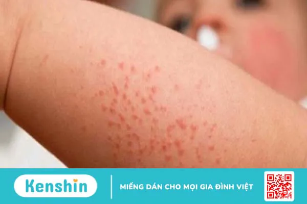 Enterogermina có tác dụng gì? 8 công dụng thuốc Enterogermina cần biết