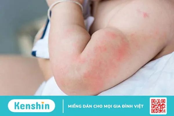 Enterogermina trẻ sơ sinh: cách dùng, liều dùng và lưu ý khi sử dụng