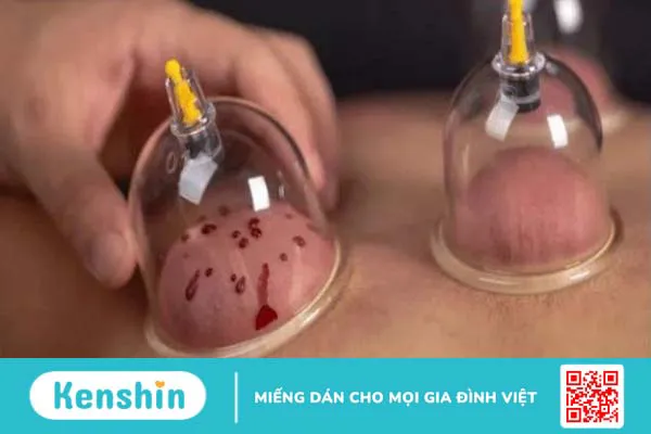 Giác hơi có tác dụng gì? Phương pháp và đối tượng không nên giác hơi