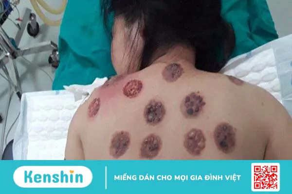 Giác hơi có tác dụng gì? Phương pháp và đối tượng không nên giác hơi