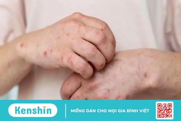 Giải đáp các thắc mắc về bệnh đậu mùa khỉ giúp hiểu rõ bệnh