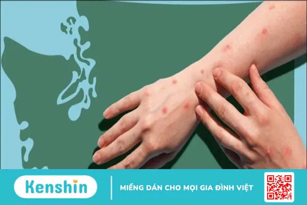 Giải đáp các thắc mắc về bệnh đậu mùa khỉ giúp hiểu rõ bệnh