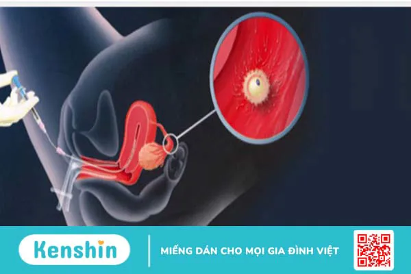 Giải pháp giúp bệnh nhân hiếm muộn có con