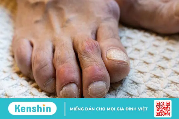 Giới thiệu viên Gout Tâm Bình mua ở đâu, có tốt không?