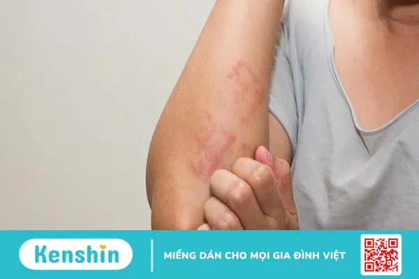 Hạt điều có tác dụng gì? 18 tác dụng của hạt điều và các lưu ý khi ăn