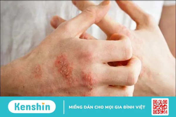 Hạt mã tiền có tác dụng gì? 9 bài thuốc và lưu ý khi chữa bệnh