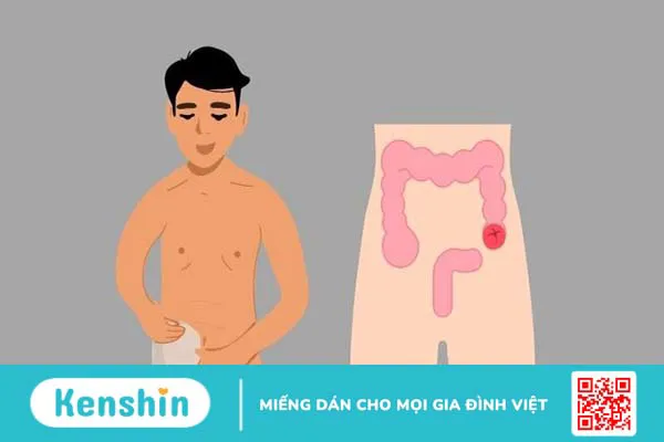 Hậu môn nhân tạo là gì? Các loại hậu môn nhân tạo và lưu ý chăm sóc