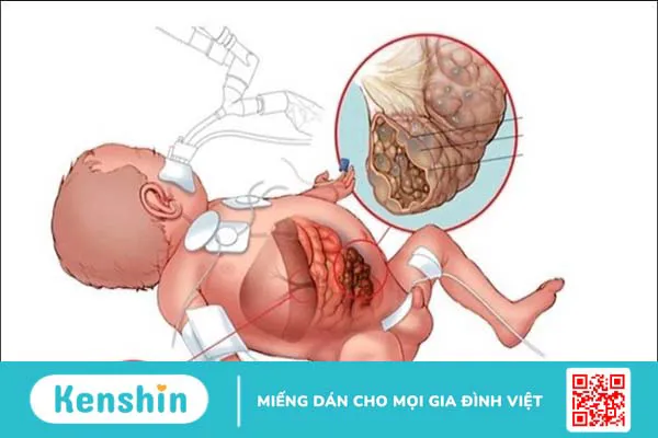 Hậu môn nhân tạo là gì? Các loại hậu môn nhân tạo và lưu ý chăm sóc