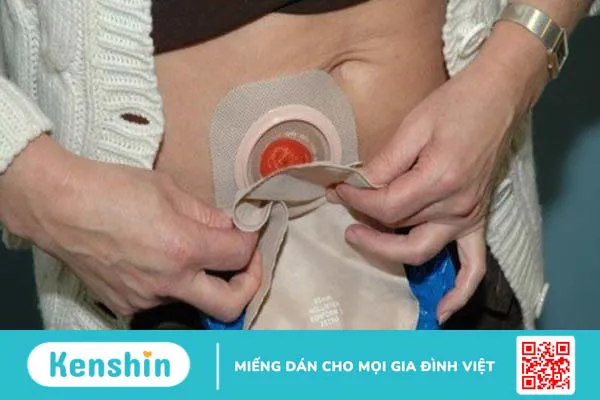 Hậu môn nhân tạo là gì? Các loại hậu môn nhân tạo và lưu ý chăm sóc