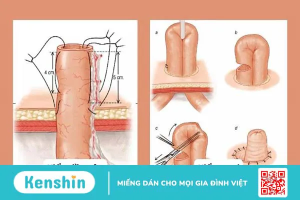 Hậu môn nhân tạo là gì? Các loại hậu môn nhân tạo và lưu ý chăm sóc