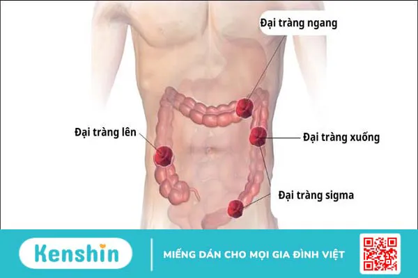 Hậu môn nhân tạo là gì? Các loại hậu môn nhân tạo và lưu ý chăm sóc