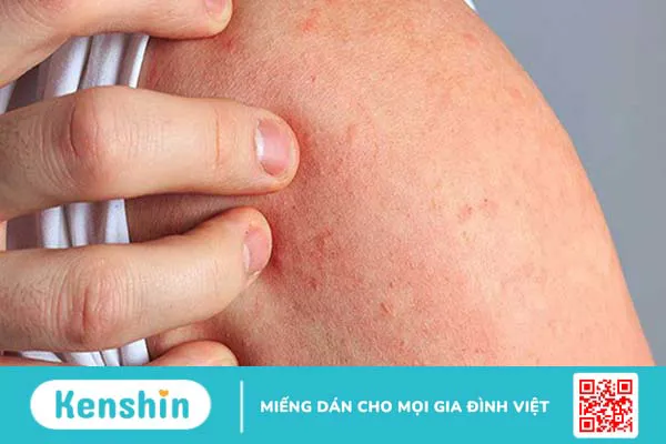 Hiểu đúng về sốc phản vệ sau khi tiêm Vaccine ngừa COVID-19