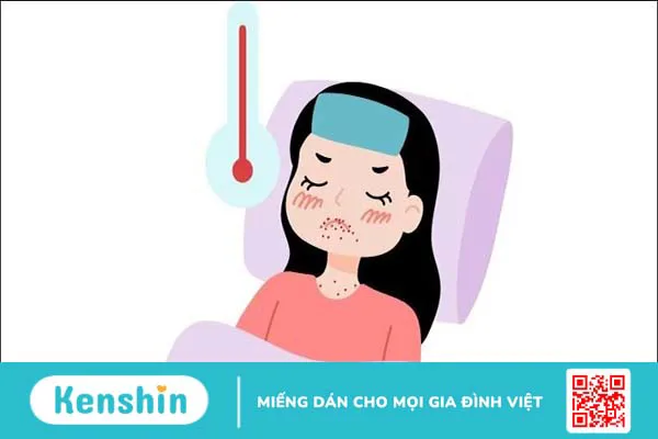 Hướng dẫn cách phân biệt thủy đậu và tay chân miệng ở trẻ em