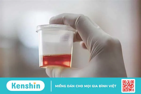 Hướng dẫn cách phòng ngừa viêm đường tiết niệu hiệu quả