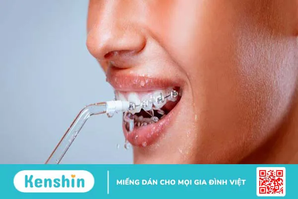 Hướng dẫn cách vệ sinh răng niềng tại nhà đúng cách