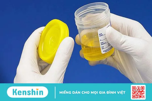 Hướng dẫn đọc các chỉ số xét nghiệm của nước tiểu bạn cần biết