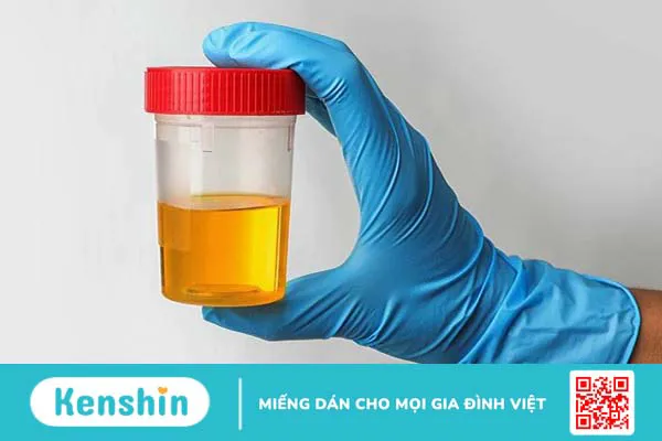 Hướng dẫn đọc các chỉ số xét nghiệm của nước tiểu bạn cần biết