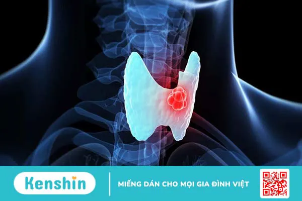 Iodine (Iốt) là gì? lợi ích, liều dùng, tác dụng phụ, những loại thực phẩm chứa nhiều i ốt