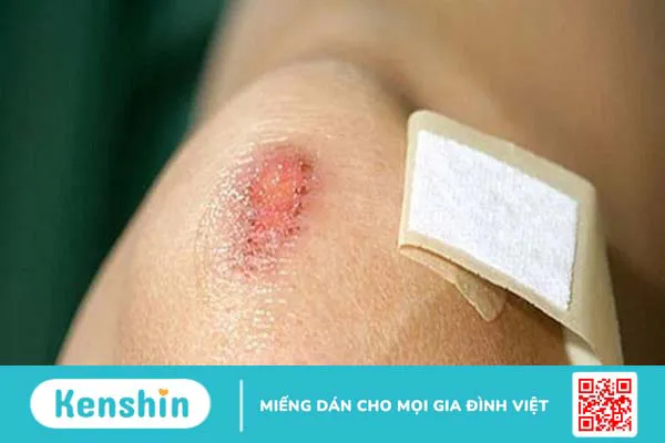 Kẽm: Cách dùng, liều dùng, tác dụng phụ