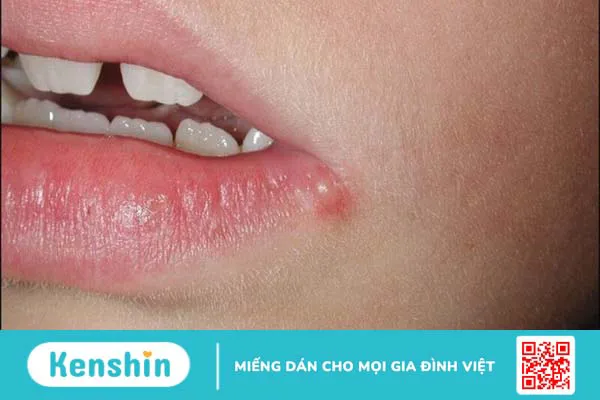 Lá sen có tác dụng gì? Đối tượng nên lưu ý khi sử dụng