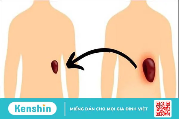 Lách to có nguy hiểm không? Cách điều trị lá lách to