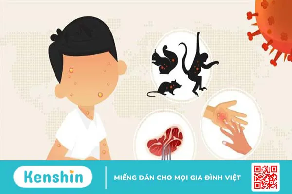 Làm sao phân biệt đậu mùa khỉ và thủy đậu khi cả hai đều có mụn nước