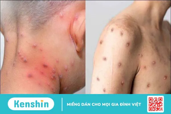 Làm sao phân biệt đậu mùa khỉ và thủy đậu khi cả hai đều có mụn nước