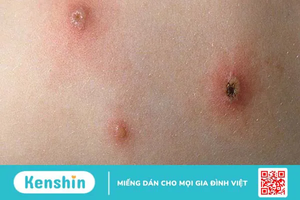 Làm sao phân biệt đậu mùa khỉ và thủy đậu khi cả hai đều có mụn nước