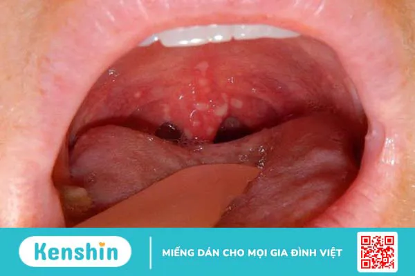 Loét họng nên ăn gì? 3 loại thực phẩm dành cho người bị loét họng