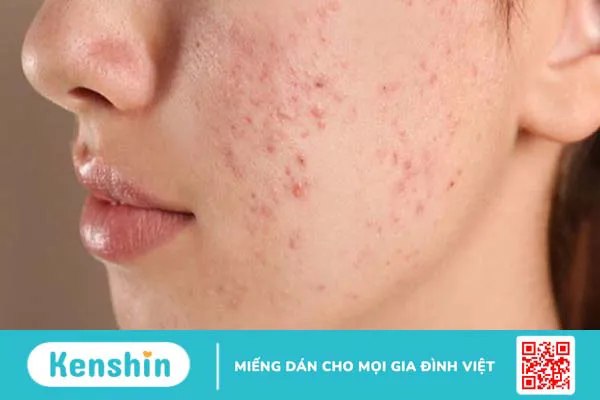 Lợi ích của dầu gấc đối với sức khỏe làn da bạn nên biết