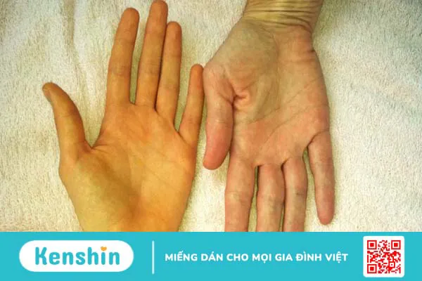 Lợi ích của việc sử dụng cà rốt cho bệnh đái tháo đường