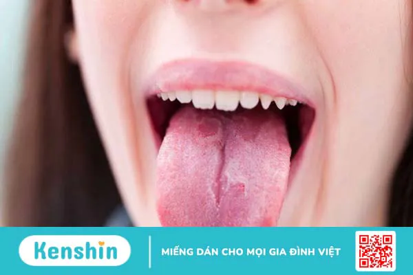 Lưỡi trắng là bệnh gì? 8 nguyên nhân phổ biến gây bệnh bạn nên biết