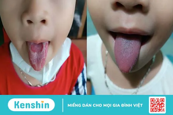 Lưỡi trắng là bệnh gì? 8 nguyên nhân phổ biến gây bệnh bạn nên biết