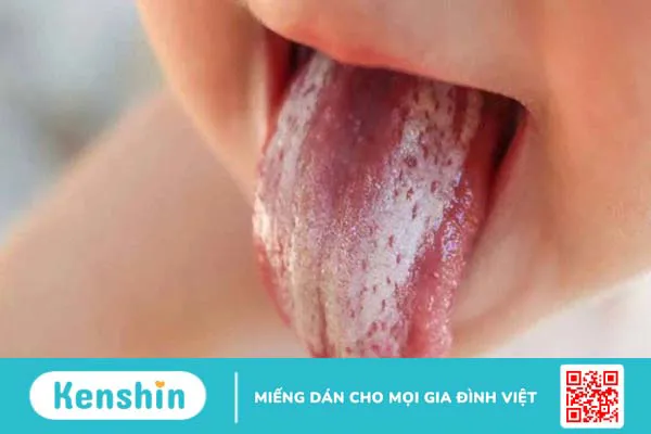 Lưỡi trắng là bệnh gì? 8 nguyên nhân phổ biến gây bệnh bạn nên biết