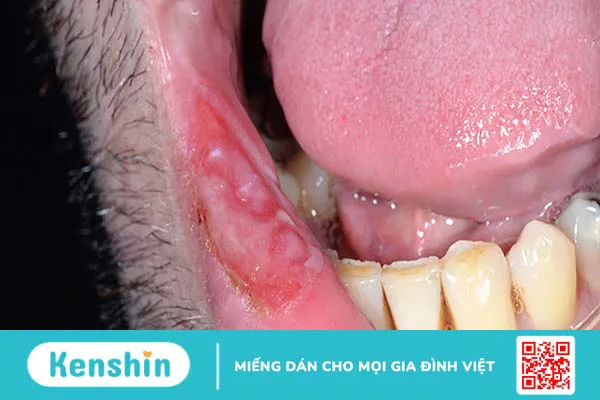 Lưỡi trắng là bệnh gì? 8 nguyên nhân phổ biến gây bệnh bạn nên biết