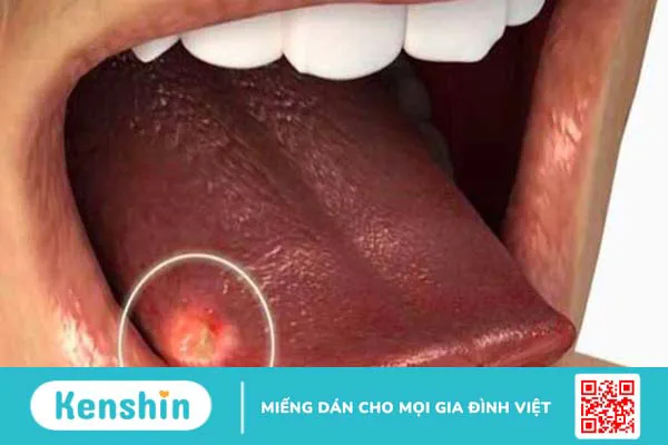 Lưỡi trắng là bệnh gì? 8 nguyên nhân phổ biến gây bệnh bạn nên biết