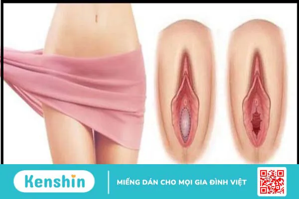 Màng trinh: vị trí, hình thành cấu tạo, và những điều bạn nên biết